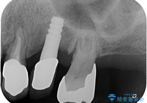 【インプラント】噛んだら痛みがあるの治療前
