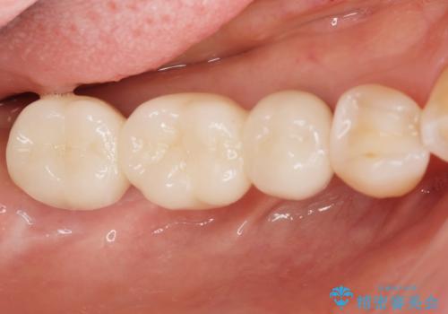 失った奥歯をインプラントで機能回復の治療後