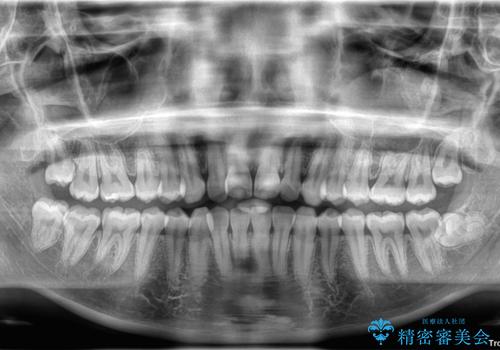 目立ちにくい表側装置で1年完了!狭いアーチを側方拡大し前歯のデコボコを整えた症例の治療前