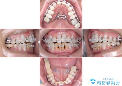 歯がボロボロで咬合崩壊 矯正・インプラント・セラミックで実現する、酸蝕症の総合治療の治療中