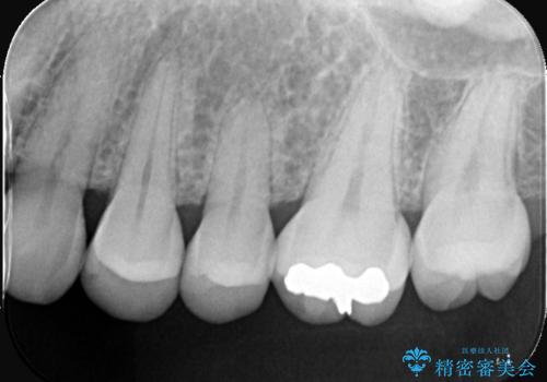 虫歯の治療 〈セラミックインレー〉の治療前