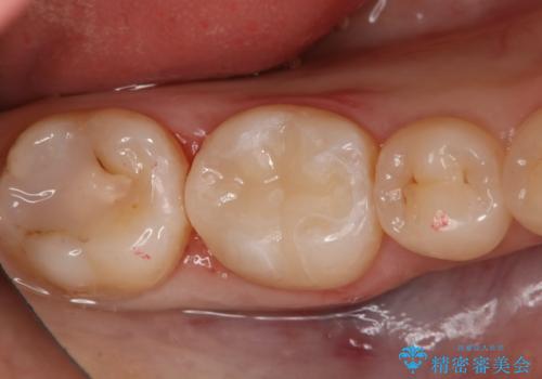 奥歯の虫歯を直したい セラミックインレー