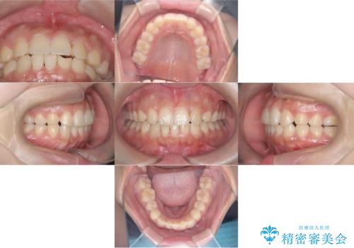 歯のデコボコを治したい! |インビザラインでわずか6ヵ月で矯正完了!の治療後