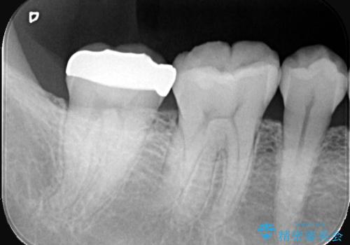 セラミッククラウンによる奥歯の修復の治療後