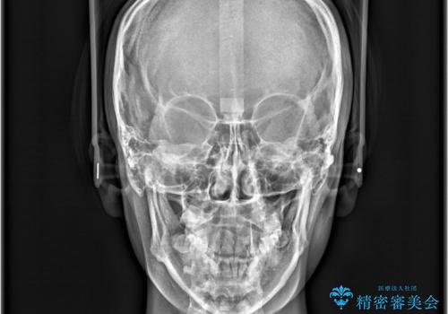 歯のデコボコを治したい! |インビザラインでわずか6ヵ月で矯正完了!の治療前