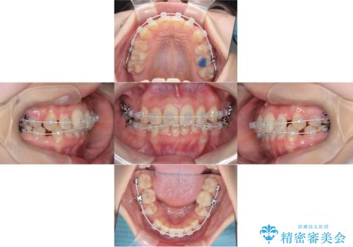 歯のデコボコ|口ボコ|八重歯が気になる!|ワイヤー矯正の治療中