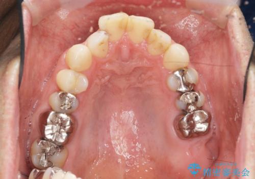 矯正と虫歯のセラミック治療 総合歯科治療の実践の治療前