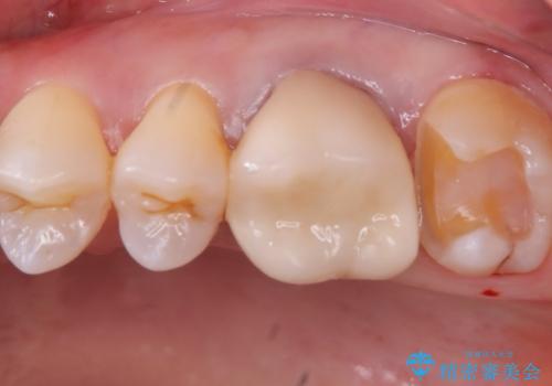 【セラミックインレー】口の中から金属を無くしたいの治療中