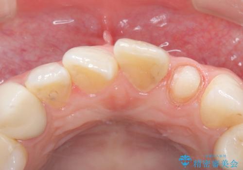 【セラミッククラウン】歯の根元が欠けた、歯が揺れている気がするの治療中