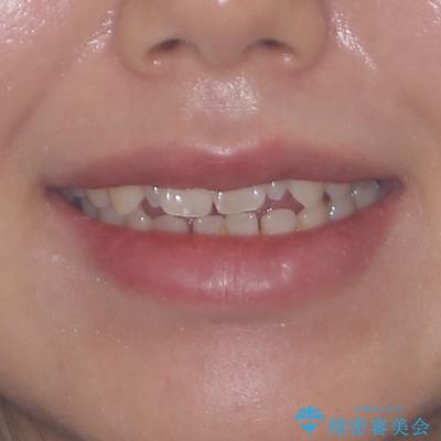 飛び出した前歯 インビザラインを用いた抜歯矯正治療の治療前(顔貌)
