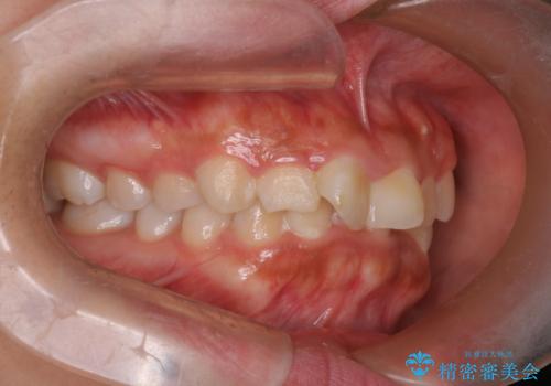 目立たない矯正で中等度の叢生を改善の治療前