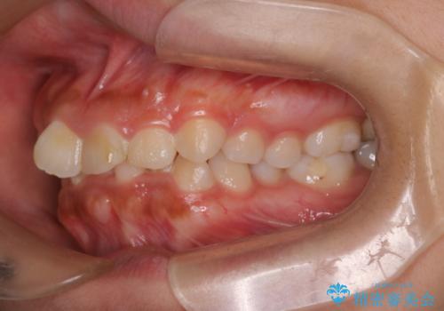 目立たない矯正で中等度の叢生を改善の治療前