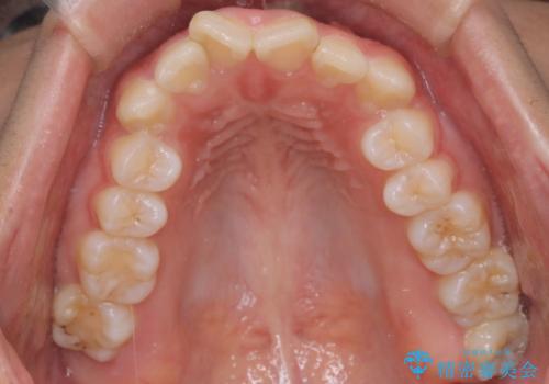 目立たない矯正で中等度の叢生を改善の治療前