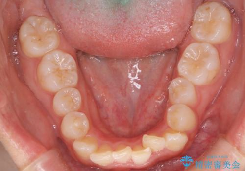 目立たない矯正で中等度の叢生を改善の治療前