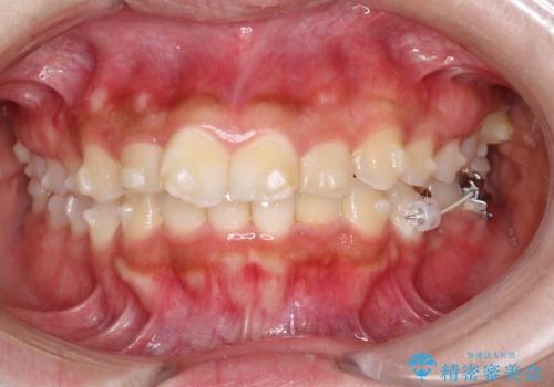 目立たない矯正で中等度の叢生を改善の治療中