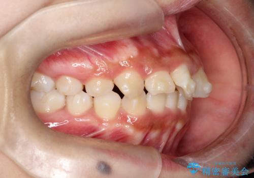 目立たない矯正で中等度の叢生を改善の治療中