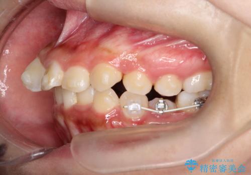 目立たない矯正で中等度の叢生を改善の治療中
