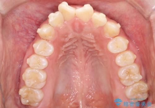目立たない矯正で中等度の叢生を改善の治療中