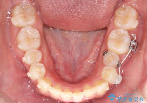 目立たない矯正で中等度の叢生を改善の治療中