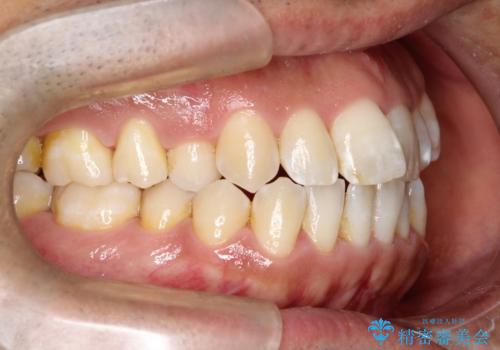 目立たない矯正で八重歯を改善の治療前
