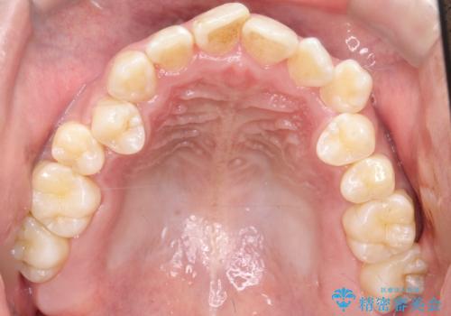目立たない矯正で八重歯を改善の治療前