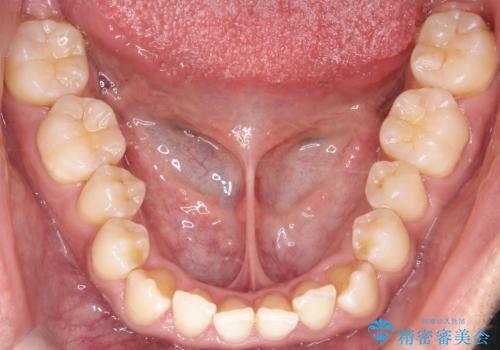 目立たない矯正で八重歯を改善の治療前