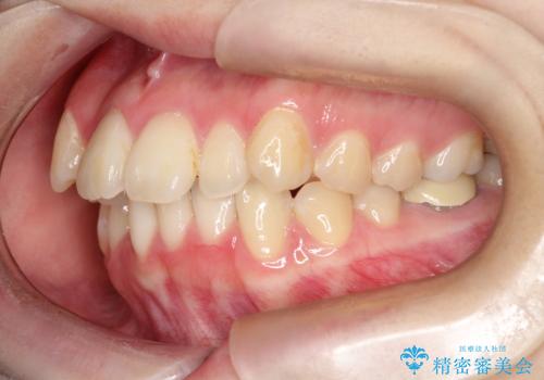 歯のデコボコ|口ボコ|八重歯が気になる!|ワイヤー矯正の治療前