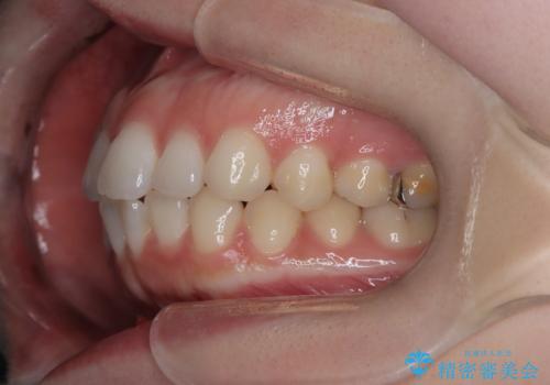 審美ワイヤー矯正とTAD併用による犬歯の遠心移動の治療前