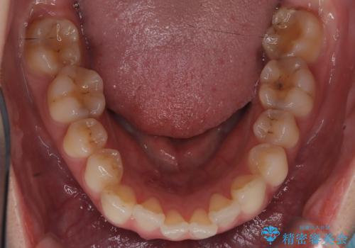 審美ワイヤー矯正とTAD併用による犬歯の遠心移動の治療前