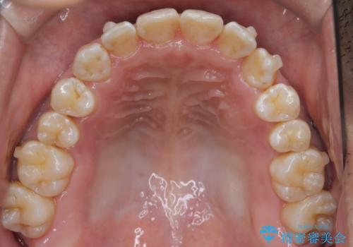 目立たない矯正で八重歯を改善の治療中