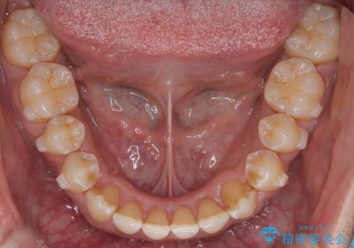 目立たない矯正で八重歯を改善の治療中