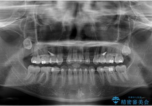 転勤でも安心して治療継続 抜歯スペース閉鎖と深い噛み合わせ改善のワイヤー矯正の治療前