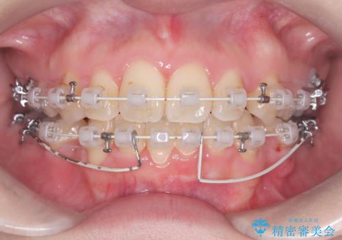 歯のデコボコ|口ボコ|八重歯が気になる!|ワイヤー矯正の治療中