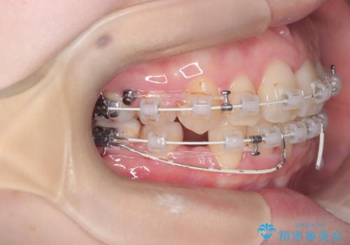 歯のデコボコ|口ボコ|八重歯が気になる!|ワイヤー矯正の治療中