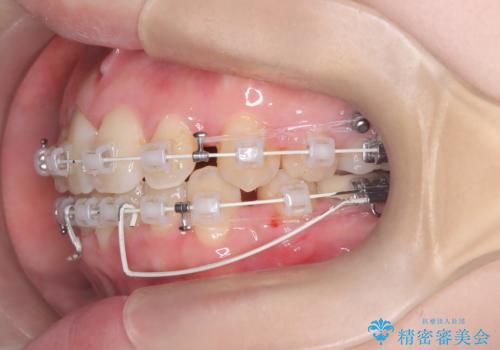 歯のデコボコ|口ボコ|八重歯が気になる!|ワイヤー矯正の治療中