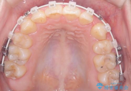 歯のデコボコ|口ボコ|八重歯が気になる!|ワイヤー矯正の治療中