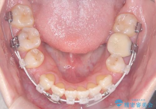 歯のデコボコ|口ボコ|八重歯が気になる!|ワイヤー矯正の治療中