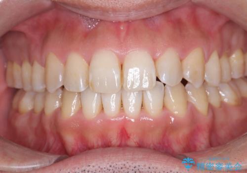 目立たない矯正で八重歯を改善の治療後