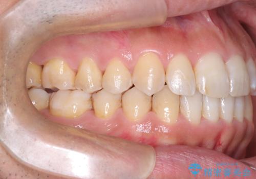 目立たない矯正で八重歯を改善の治療後