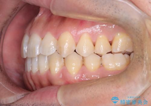 目立たない矯正で八重歯を改善の治療後