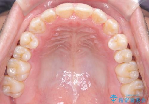 目立たない矯正で八重歯を改善の治療後