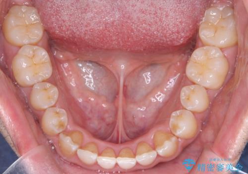 目立たない矯正で八重歯を改善の治療後