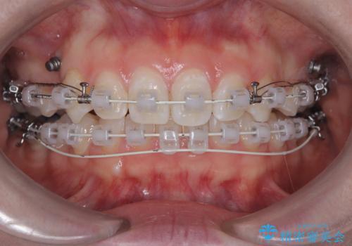八重歯と歯のズレを解消し、整った笑顔への治療中