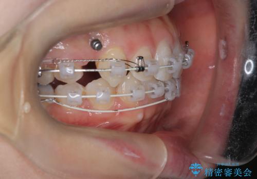 八重歯と歯のズレを解消し、整った笑顔への治療中