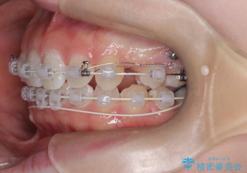 八重歯と歯のズレを解消し、整った笑顔への治療中