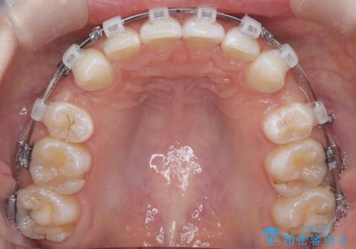 八重歯と歯のズレを解消し、整った笑顔への治療中
