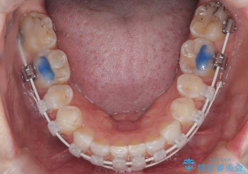 八重歯と歯のズレを解消し、整った笑顔への治療中