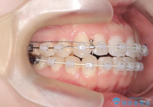 審美ワイヤー矯正とTAD併用による犬歯の遠心移動の治療中