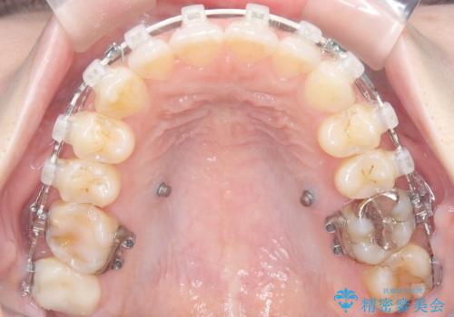 審美ワイヤー矯正とTAD併用による犬歯の遠心移動の治療中