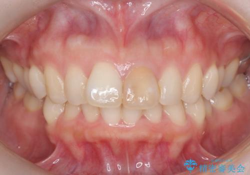 前歯の変色を改善し、本来の自然な美しさへの治療前